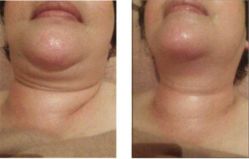 -苑苑vbeauty科技美容SPA