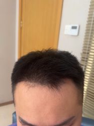 -大麦微针植发丨全国连锁