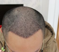 -大麦微针植发丨全国连锁