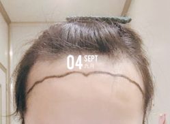 -大麦微针植发全国连锁