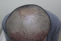 点击看大图 -大麦微针植发丨全国连锁