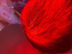 -碧莲盛·不剃发植发