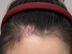 体验后-碧莲盛·不剃发植发