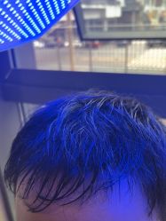 -碧莲盛·不剃发植发