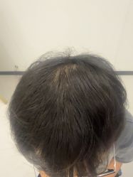 -大麦微针植发全国连锁