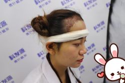 -大麦微针植发丨全国连锁