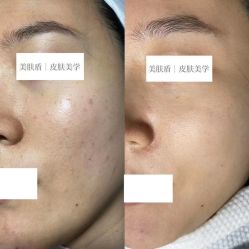 -美肤盾祛痘·问题肌头疗管理中心