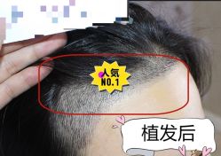-大麦微针植发全国连锁