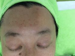 -苗医生草本科技祛痘