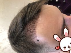 -大麦微针植发丨全国连锁