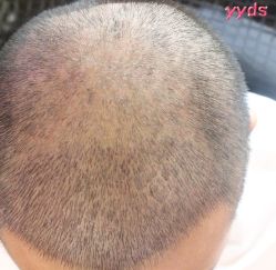 -大麦微针植发丨全国连锁