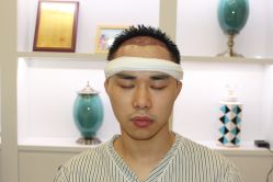 -大麦微针植发丨全国连锁