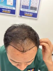 -大麦微针植发全国连锁