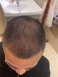 点击看大图 -碧莲盛·不剃发植发