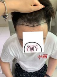 体验前-大麦微针植发全国连锁