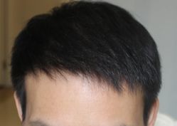 -大麦微针植发丨全国连锁