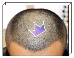 -大麦微针植发全国连锁