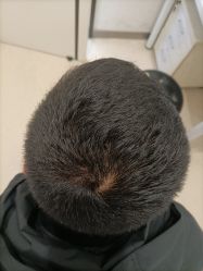 点击看大图 体验后-大麦微针植发丨全国连锁