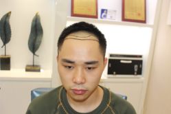 -大麦微针植发丨全国连锁