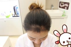 -大麦微针植发丨全国连锁