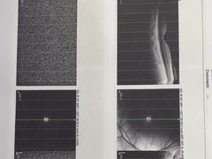 -成都新视界眼科医院·近视手术·儿童近视