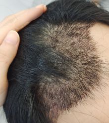 -大麦微针植发全国连锁