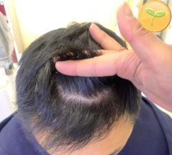 -大麦微针植发丨全国连锁