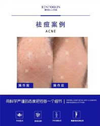 点击看大图 -靓芙泉专研痘痘肌