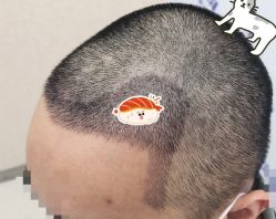 -大麦微针植发全国连锁