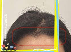 -大麦微针植发全国连锁