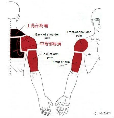 背阔肌疼痛怎么办图片