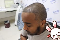 -大麦微针植发丨全国连锁