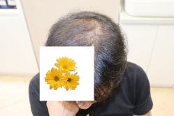 -大麦微针植发丨全国连锁
