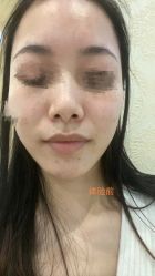 体验前-杭州米兰柏羽医疗美容医院