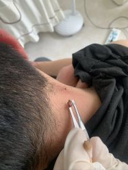 -美丽人生祛斑扁平疣汗管瘤中心
