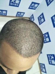 -大麦微针植发丨全国连锁