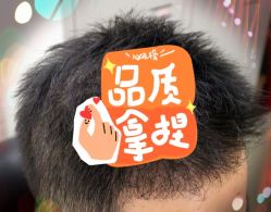 -大麦微针植发全国连锁