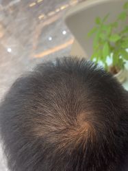 -碧莲盛·不剃发植发