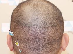 -大麦微针植发全国连锁