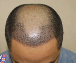 -大麦微针植发丨全国连锁