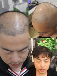 -大麦微针植发全国连锁