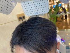 -碧莲盛·不剃发植发