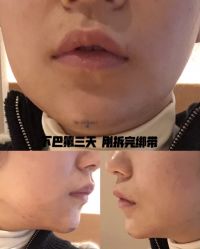 体验后-西安壹加壹医疗美容·西北抗衰旗舰店