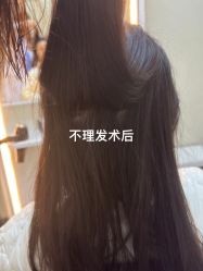 体验后-大麦微针植发全国连锁