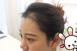 -大麦微针植发丨全国连锁