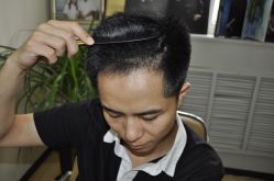 -大麦微针植发丨全国连锁