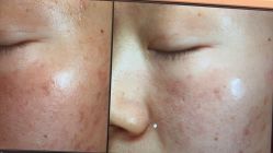 -苑苑vbeauty科技美容SPA
