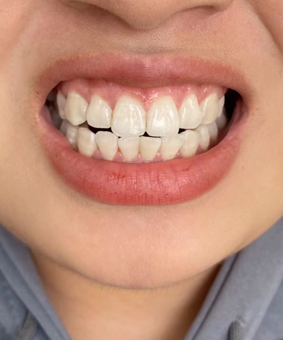 亮白牙齿自然闪耀