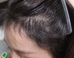 -大麦微针植发丨全国连锁