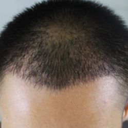 -大麦微针植发丨全国连锁